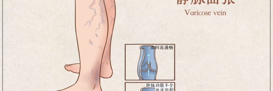 告別“蚯蚓腿”，靜脈曲張?jiān)趺凑{(diào)？