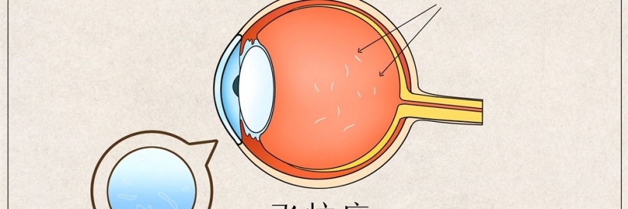 “蚊子”在眼里飛？這類人要注意了！