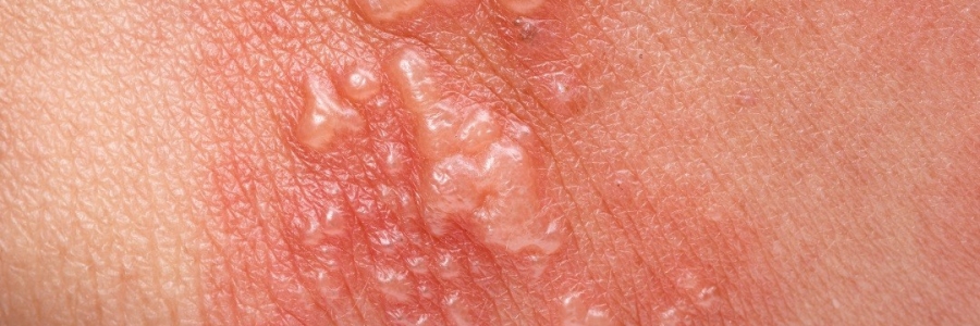 艾灸后起了小水泡，居然是邪氣在“逃跑”！