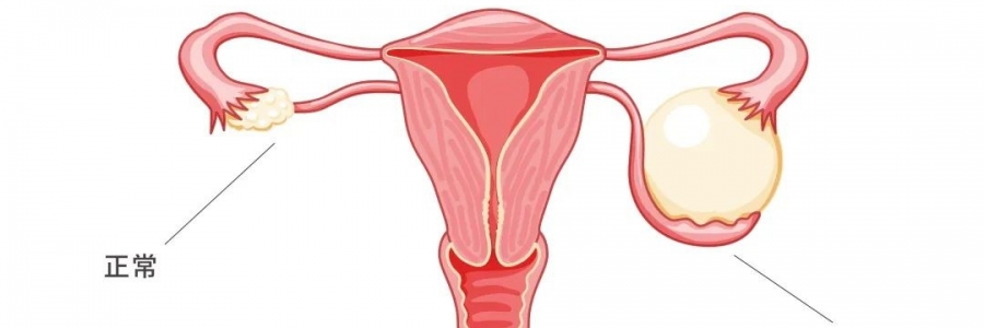太神奇了，艾灸調(diào)好了她的卵巢囊腫！